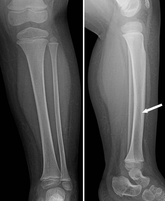 AP and lateral whole-leg radiographs showing a subtle nondisplaced oblique tibial fracture visible only on the lateral view.