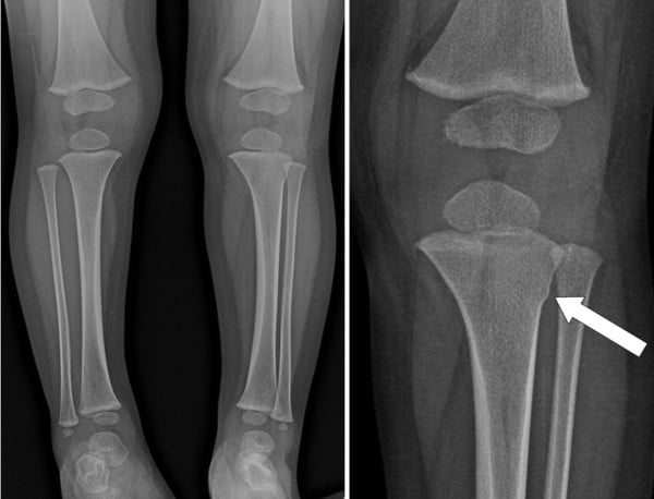 Whole-leg radiograph and magnified proximal tibial metaphysis showing a subtle torus fracture in a limping toddler.
