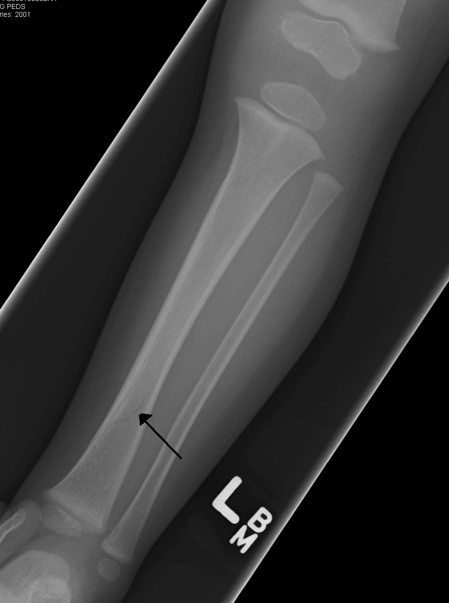 AP lower-leg radiograph of a young child showing a subtle nondisplaced spiral fracture of the distal tibia.