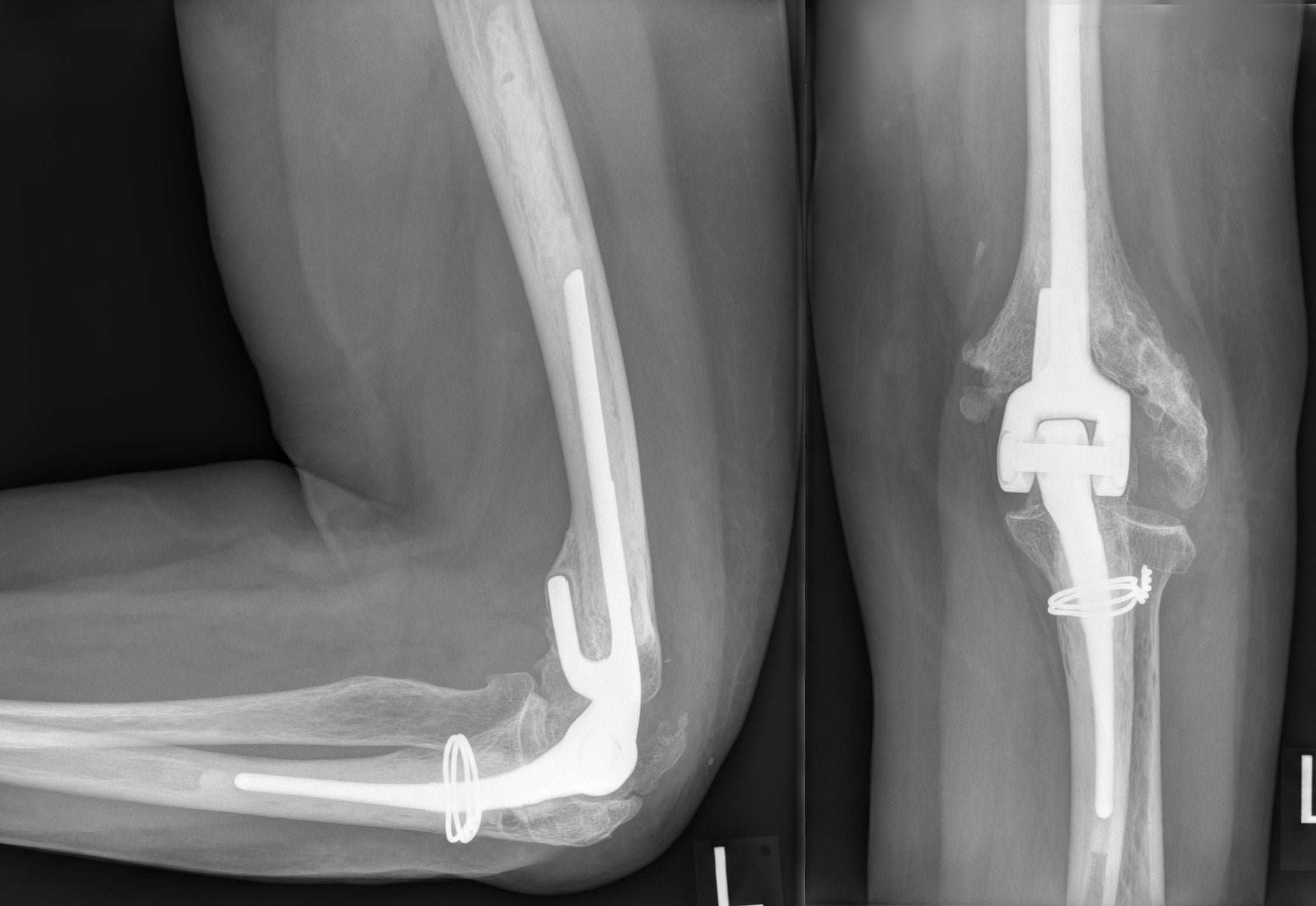 AP and lateral radiographs of a total elbow arthroplasty.