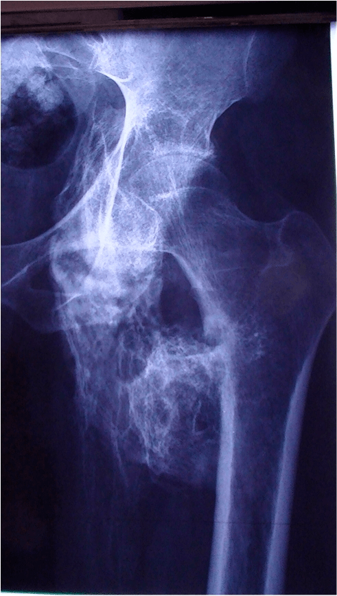 Radiograph showing Brooker class IV medial heterotopic ossification of the hip