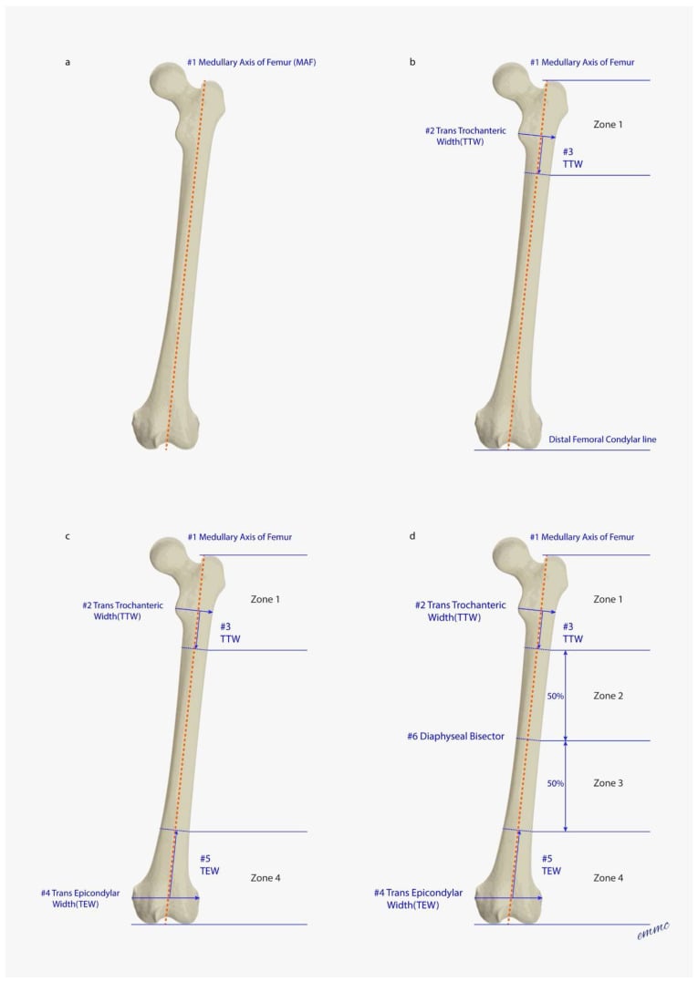 Sequential diagrams defining periprosthetic femoral fracture zones