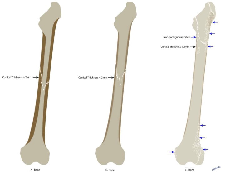 Diagrammatic illustrations of bone quality descriptors based on cortical thickness