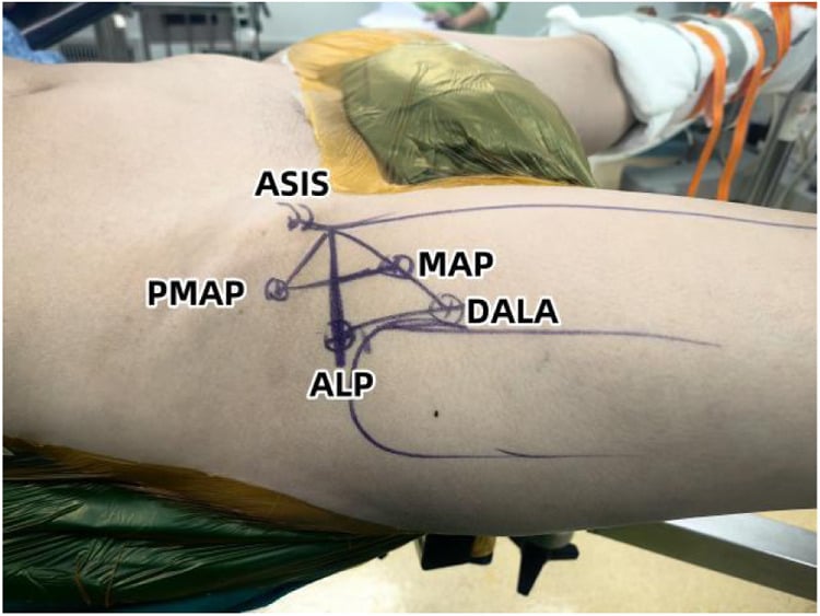 Position of hip arthroscopy portals and operating instruments on the draped limb