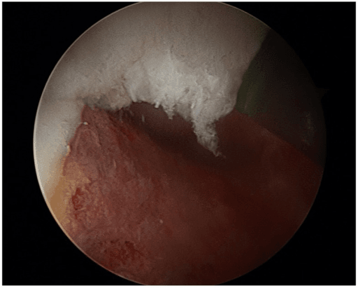 Arthroscopic view of the hip following cam resection