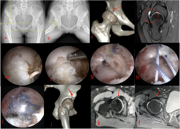 Arthroscopic labral repair with femoroacetabular osteoplasty and capsular reconstruction