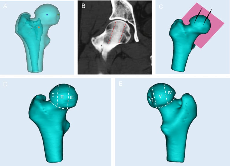 Diagram dividing the femoral head into six regions for mapping cystic lesions