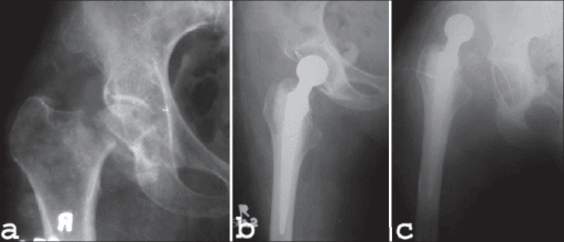 Anteroposterior radiographs of a Garden IV Pauwels II subcapital femoral neck fracture before and after surgery