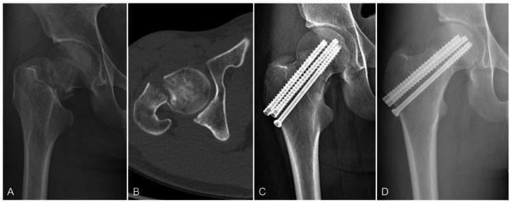 Preoperative radiograph and CT of a Garden IV Pauwels III femoral neck fracture in a young adult