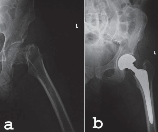 Preoperative and postoperative radiographs of a femoral neck fracture treated by hemiarthroplasty