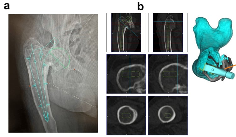 Two-dimensional and three-dimensional preoperative templating for total hip arthroplasty
