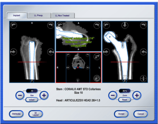 Stem implant CAD model superimposed on CT data with antetorsion measured