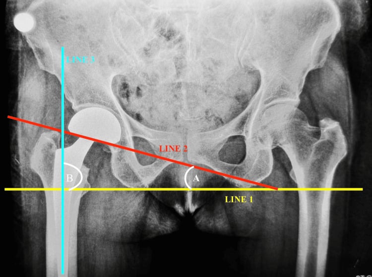 Neutral anteroposterior pelvis radiograph with reference lines and angular measurements marked