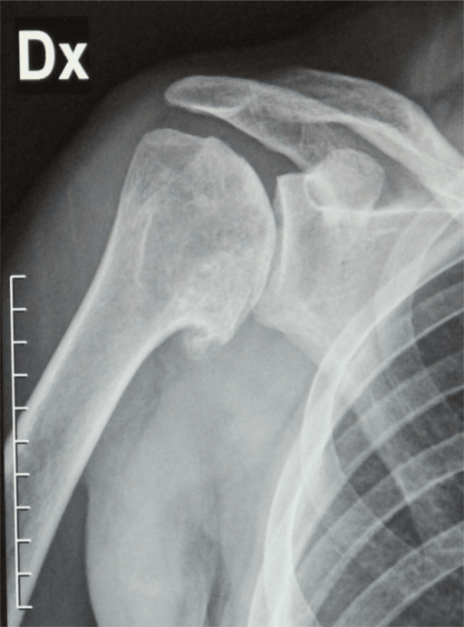 X-ray in true AP view shows severe gleno-humeral osteoarthritis with complete obliteration of joint space, glenoid erosion, and the humeral and glenoid osteophytes.