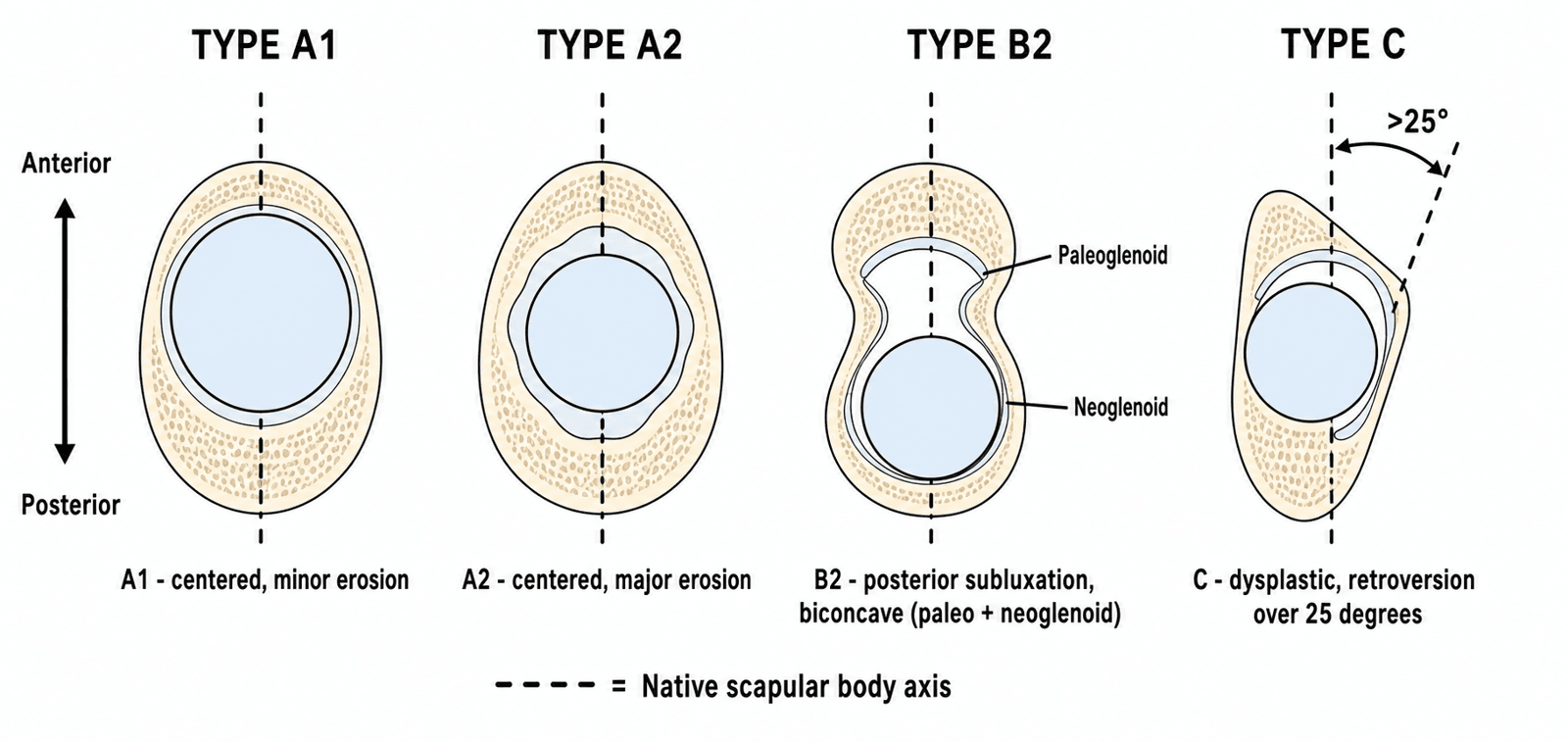 Axial schematic of the Walch glenoid classification comparing types A1, A2, B2 and C relative to the native scapular body axis
