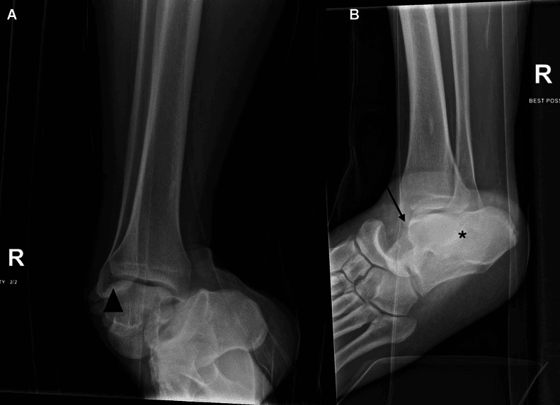Two radiographs of a right ankle, labelled A and B, showing a closed total talar dislocation