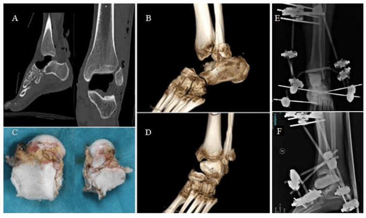 CT, volume-rendered images, a photograph of the extruded bone and radiographs in an external fixator after complete talar extrusion