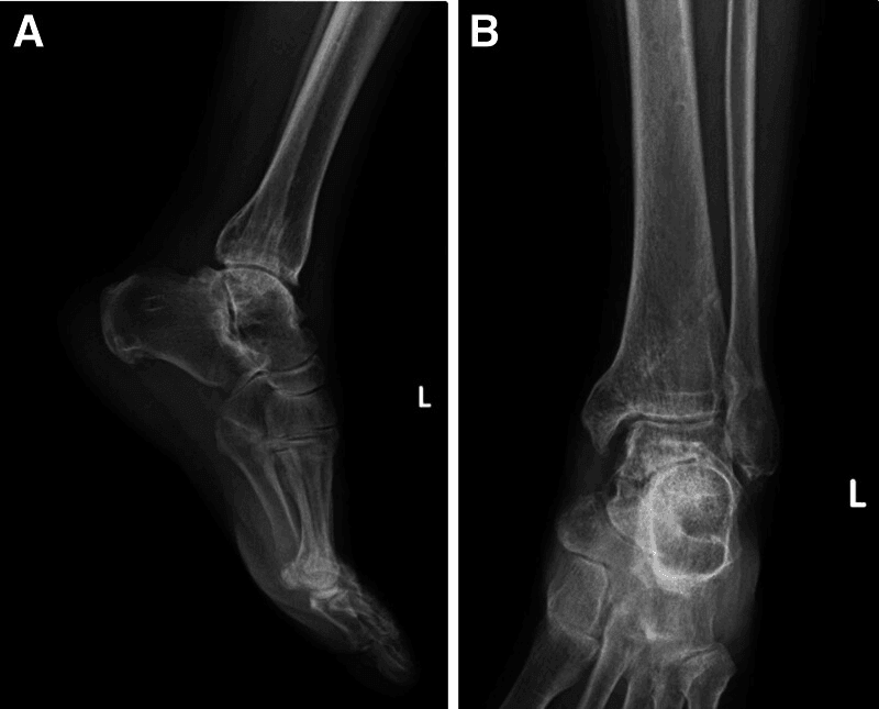 Lateral (A) and frontal (B) radiographs of a left ankle five years after reconstruction of a talar fracture-dislocation
