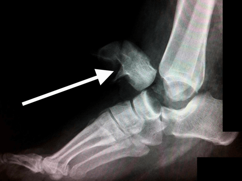 Lateral radiograph of an open pan-talar dislocation with an arrow on the displaced talus