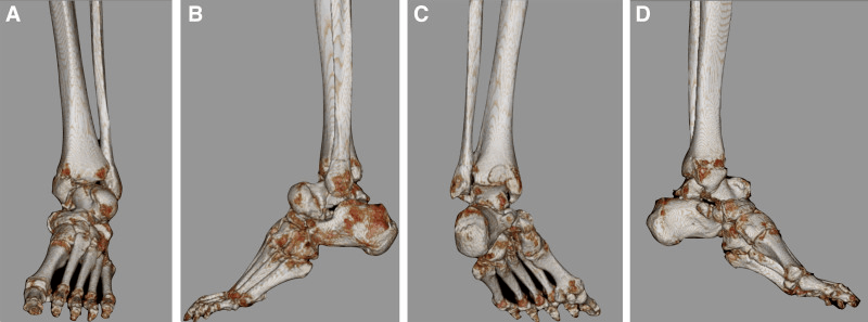 Four three-dimensional CT reconstructions, labelled A to D, of a pan-talar dislocation with talar-body fracture and associated malleolar injury