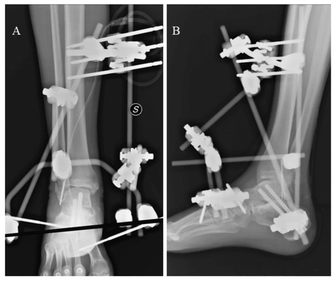 Frontal (A) and lateral (B) radiographs after talar reimplantation with subtalar arthrodesis, in an external fixator