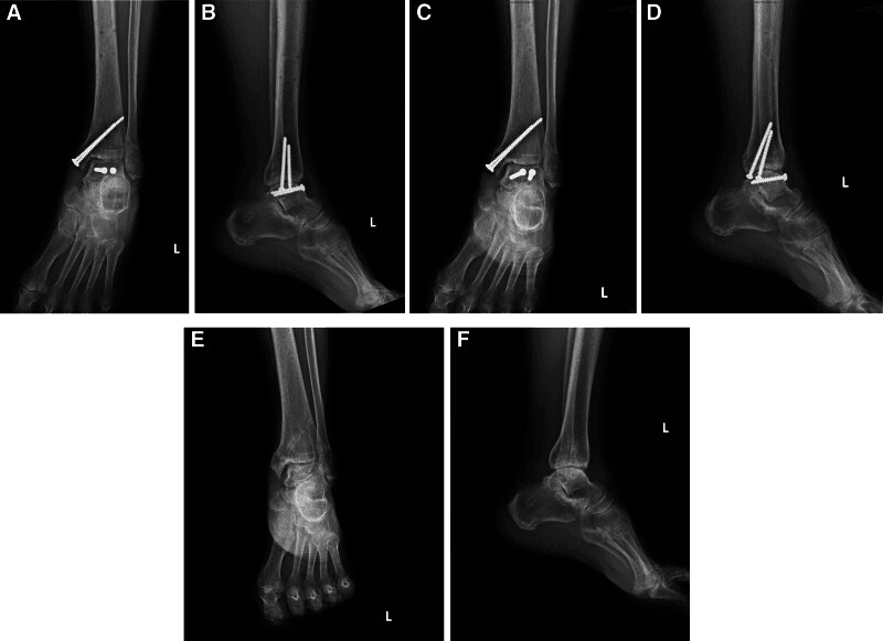Serial radiographs of a left ankle, labelled A to F, after talar reimplantation and screw fixation and after implant removal