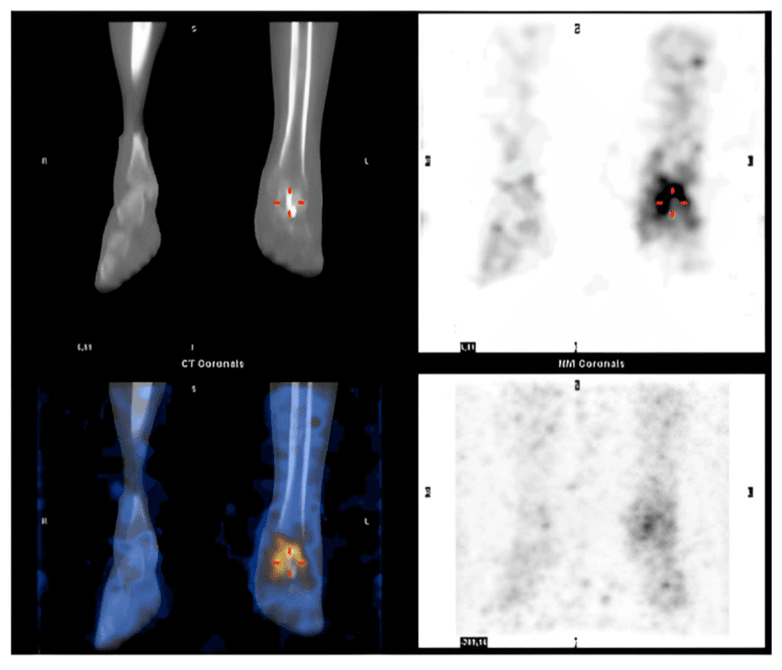 SPECT-CT coronal images with focal tracer uptake at the left ankle around a reimplanted talus in suspected deep infection