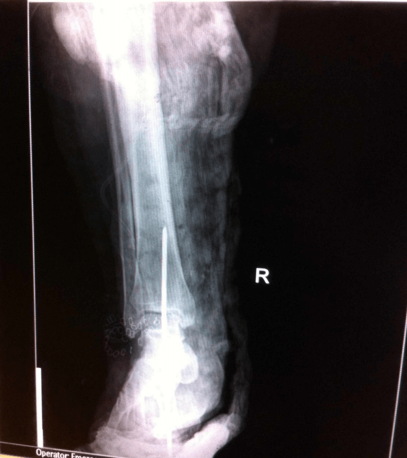 Frontal radiograph of a right ankle after open reduction, with a Steinmann pin passed up through the heel into the tibia