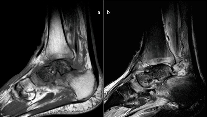 Sagittal T1 (a) and STIR (b) MRI showing talar avascular necrosis and osteomyelitis
