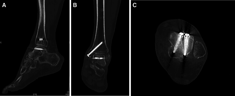 Sagittal, coronal and axial CT at ten months, labelled A to C, showing union after staged talar reconstruction