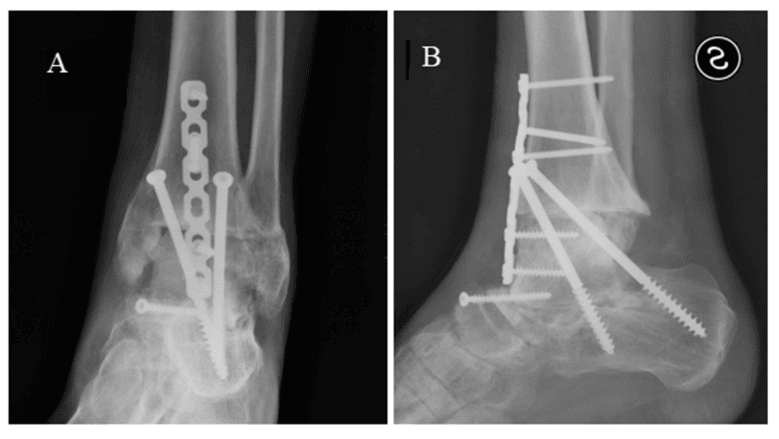 Frontal (A) and lateral (B) radiographs of a tibiocalcaneal arthrodesis with an anterior plate and screws