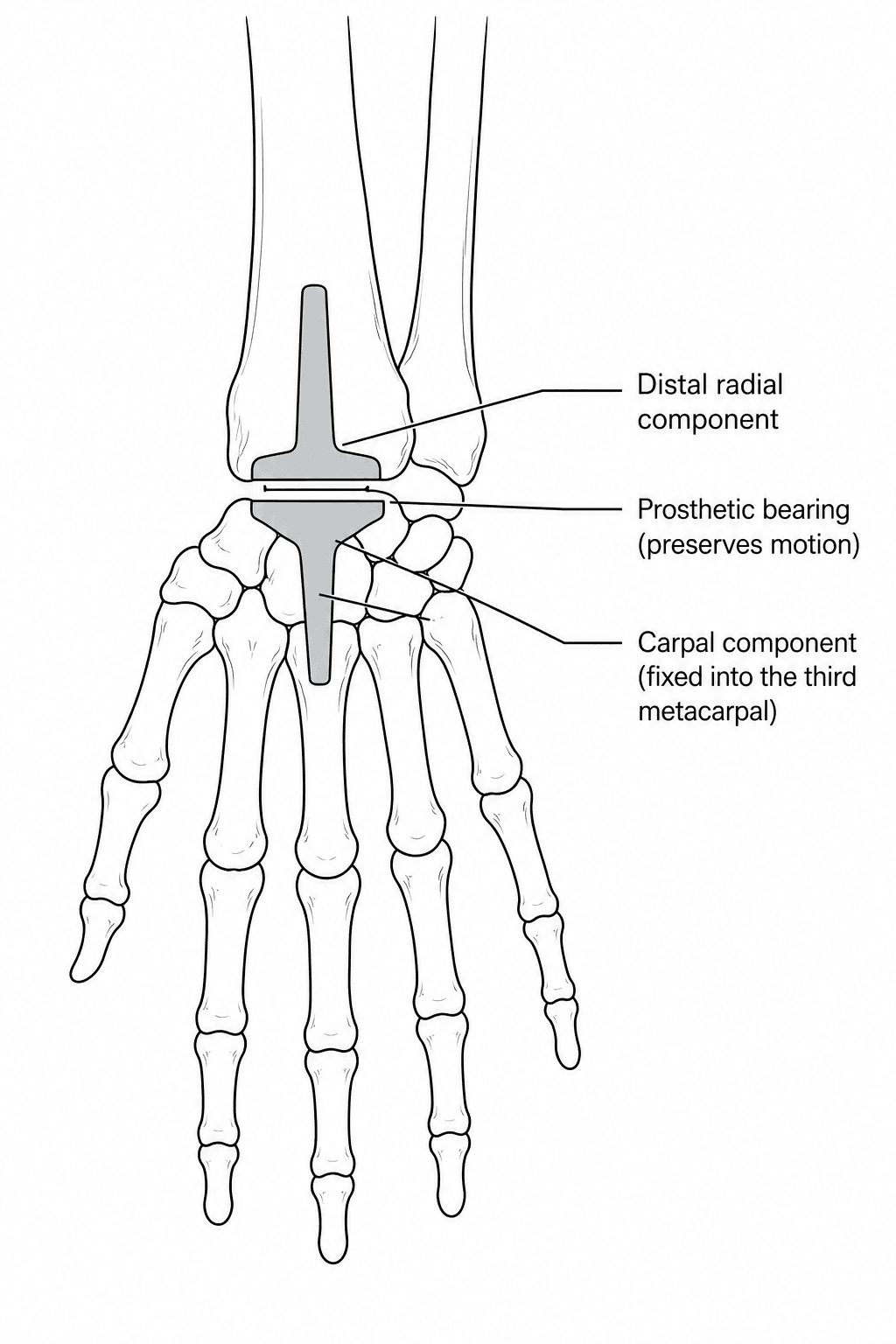 Diagram of a total wrist arthroplasty showing a distal radial component and a carpal component fixed into the third metacarpal