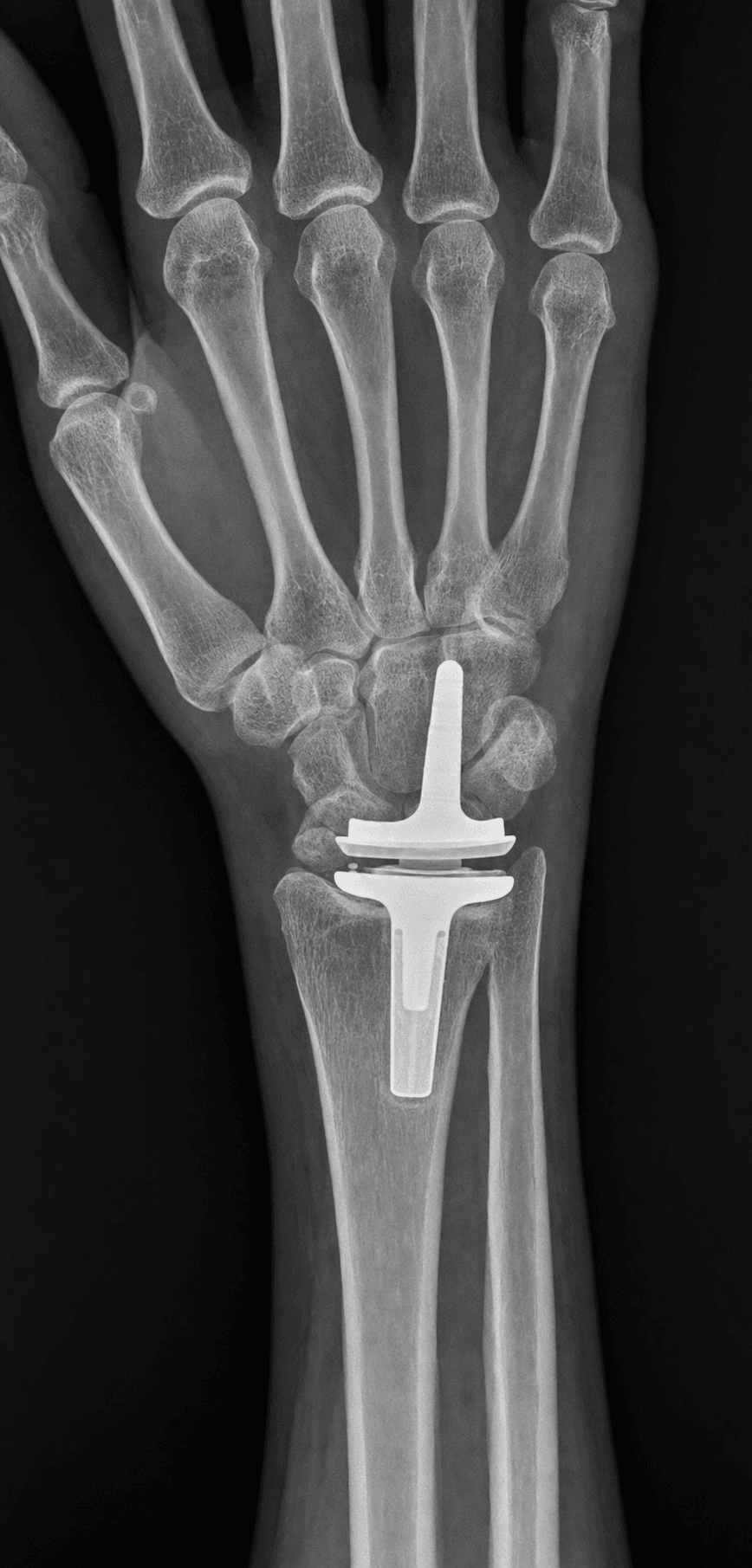 PA wrist radiograph after total wrist arthroplasty showing a distal radial component and a carpal component