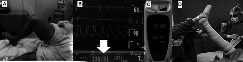 Four-panel source figure showing tourniquet cuff placement, blood-pressure measurement, cuff inflation and limb exsanguination