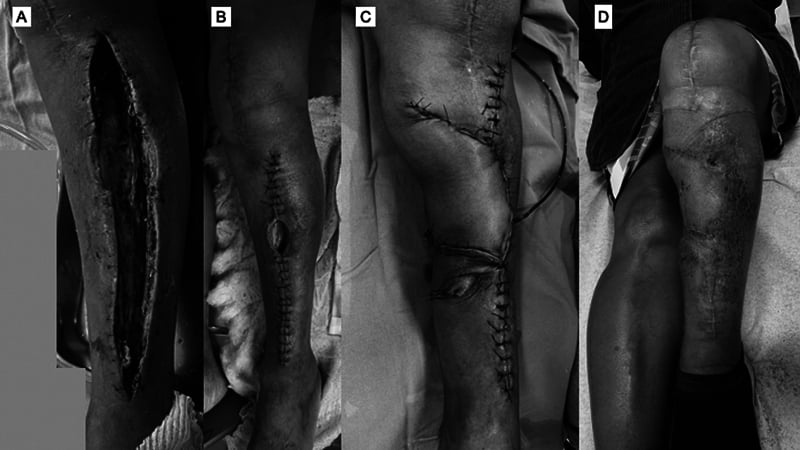 Clinical photograph of a limb with acute compartment syndrome after total knee arthroplasty