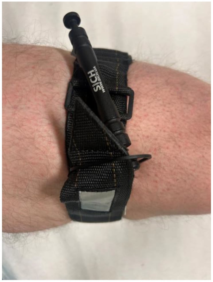 Windlass tourniquet applied to the mid-thigh with the timing strap secured