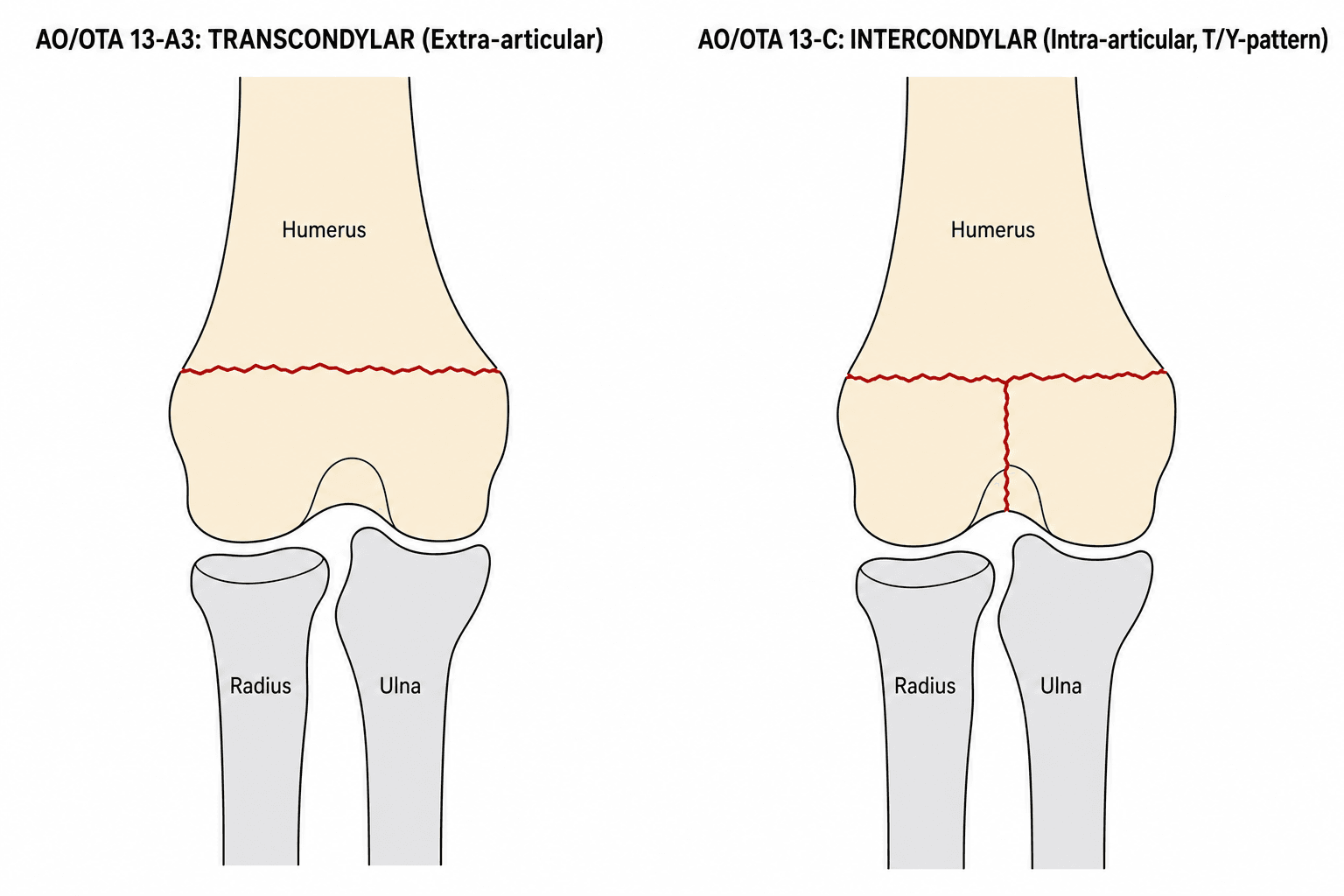 Schematic comparing AO/OTA 13-A3 transcondylar (extra-articular) and 13-C intercondylar (intra-articular, T/Y-pattern) distal humerus fractures