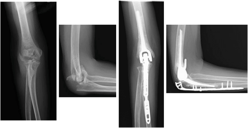 AP and lateral elbow radiographs of a distal humerus fracture, and AP and lateral radiographs after total elbow arthroplasty with a plate along the ulna