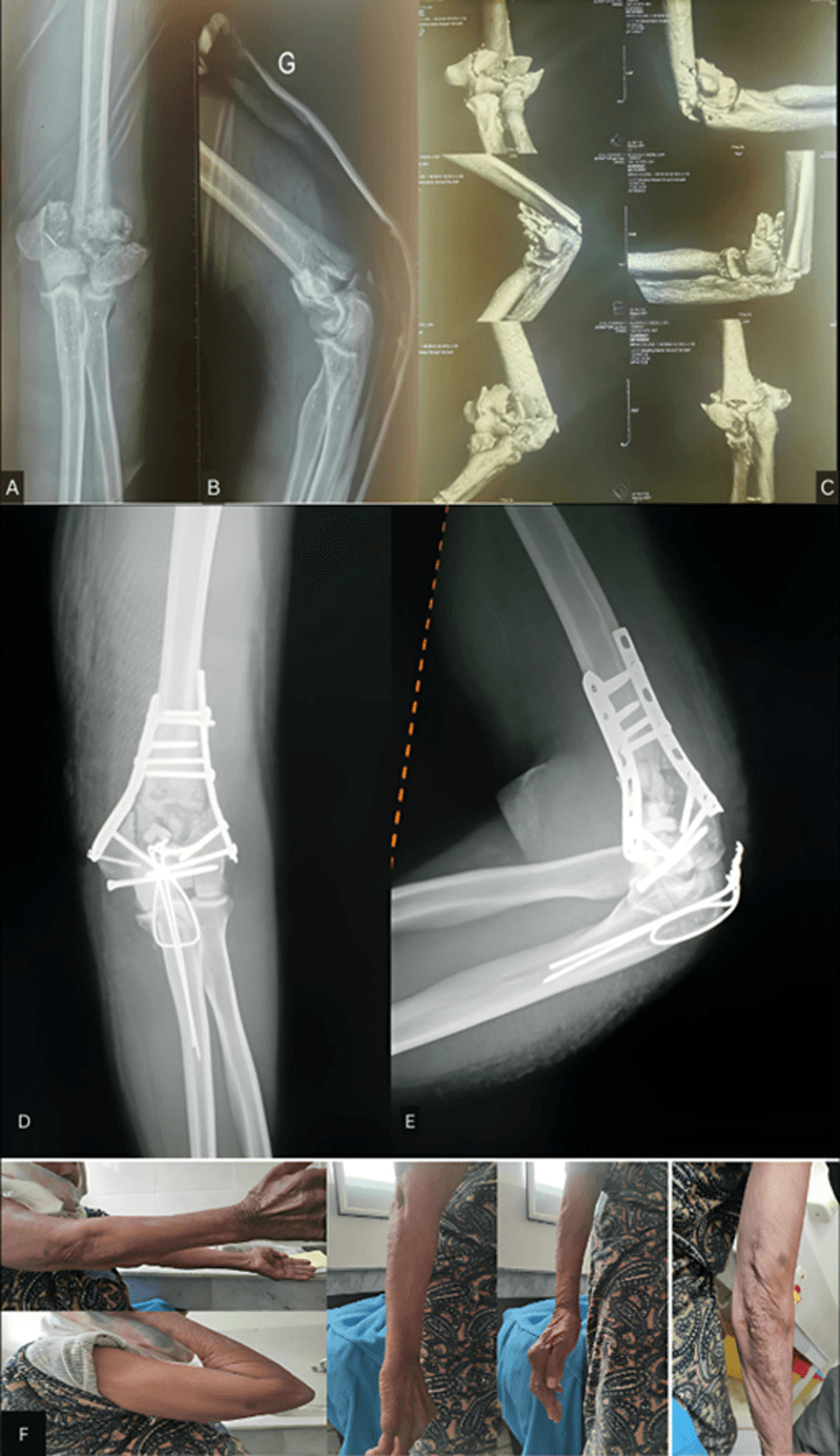 Panelled figure of a complete articular Type C distal humerus fracture: AP and lateral radiographs, three-dimensional CT reconstructions, post-operative radiographs after dual-plate fixation, and clinical photographs
