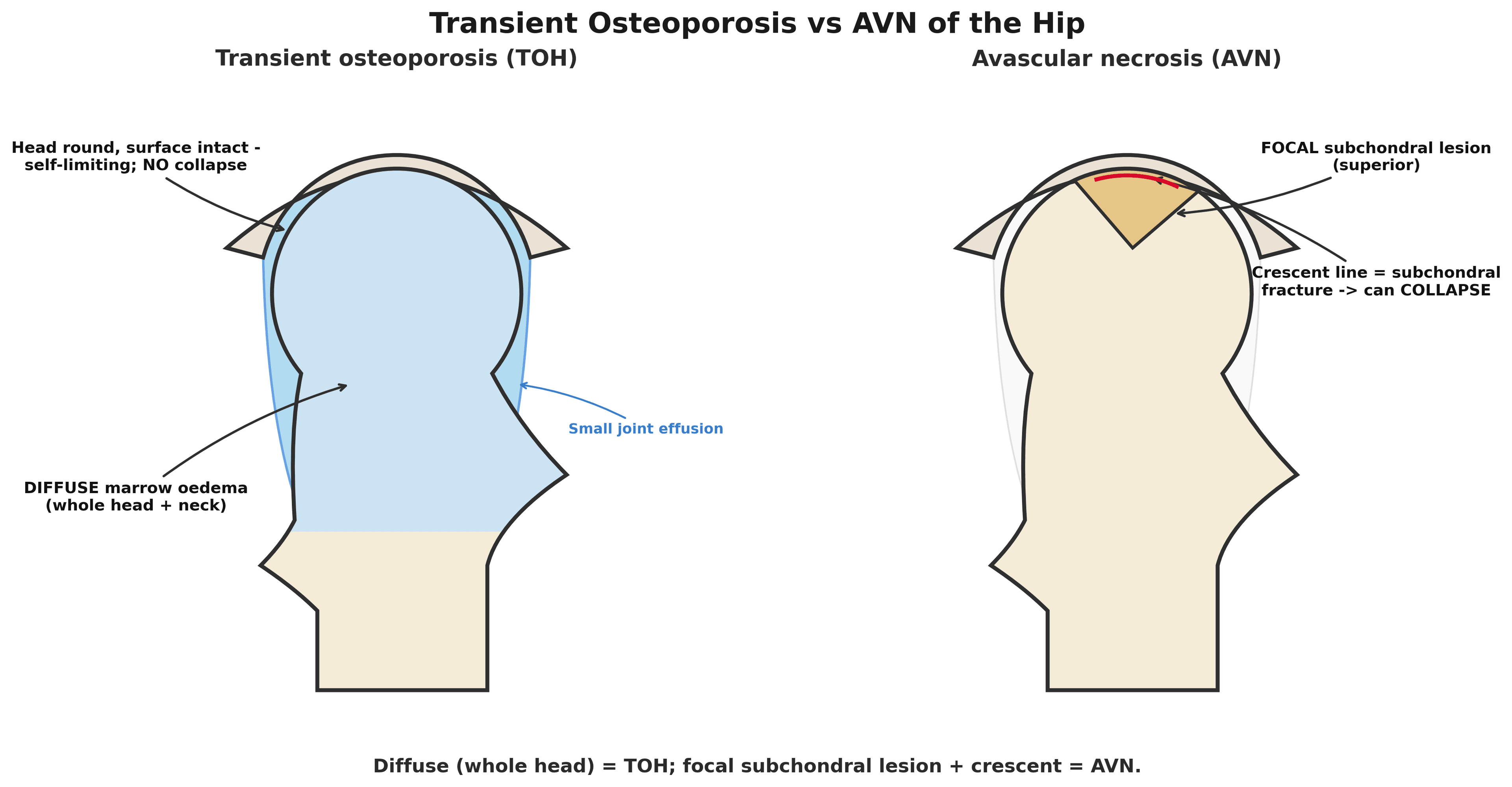 Diagram comparing transient osteoporosis of the hip (diffuse marrow oedema of the whole femoral head and neck) with avascular necrosis (a focal superior subchondral lesion and crescent line)