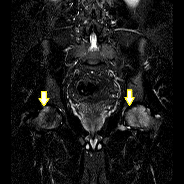 Coronal STIR MRI of the pelvis showing bilateral femoral head marrow oedema with the double-line sign of avascular necrosis