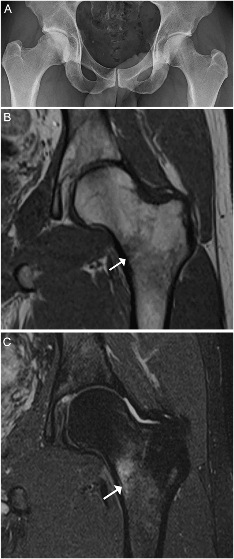 Normal hip radiograph with later MRI showing bone marrow oedema of a femoral neck stress fracture