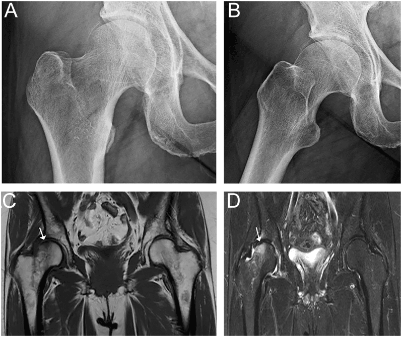 Radiographs and MRI of a subchondral insufficiency fracture of the femoral head showing a low-signal band on T1 and T2 fat-suppressed images