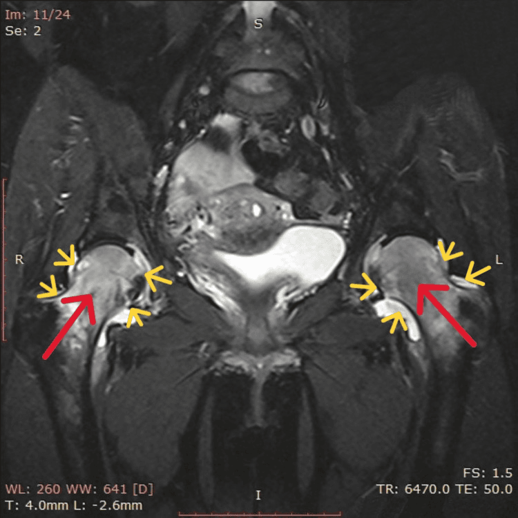 Coronal MRI showing bilateral femoral head and neck bone marrow oedema with hip joint effusions in pregnancy-related transient osteoporosis