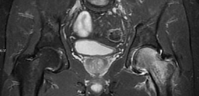 STIR coronal MRI of the pelvis showing diffuse bone marrow oedema of one femoral head in transient osteoporosis