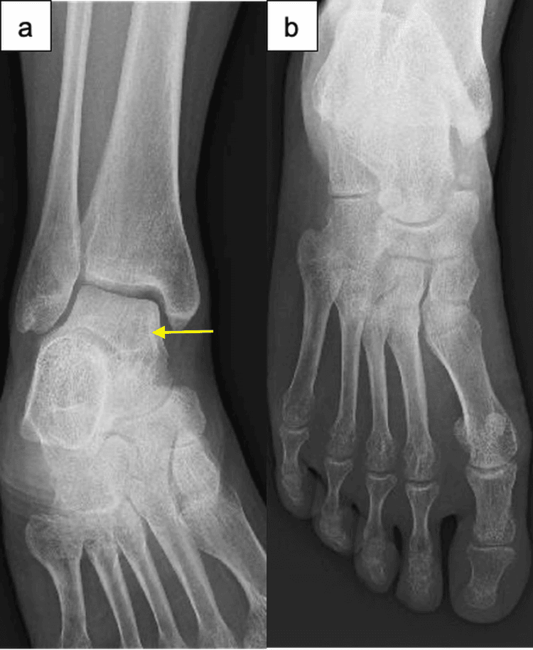 Serial ankle and foot radiographs eight months postpartum showing complete normalization of bone density