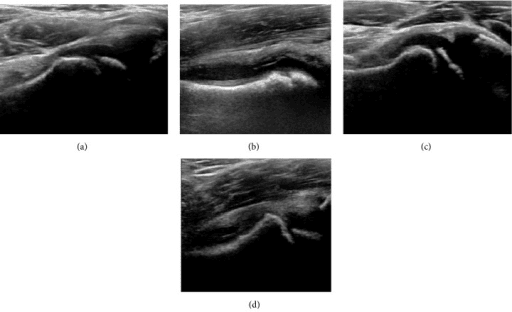 Four-panel hip ultrasound comparing the normal femoral head-neck junction, a joint effusion, femoral-head flattening and a head-neck step
