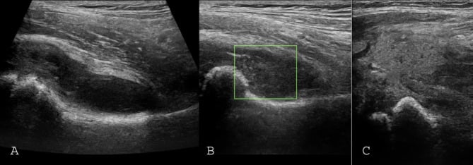 Three ultrasound panels, A to C, showing septated effusion, avascular debris and capsule perforation in late paediatric septic arthritis.