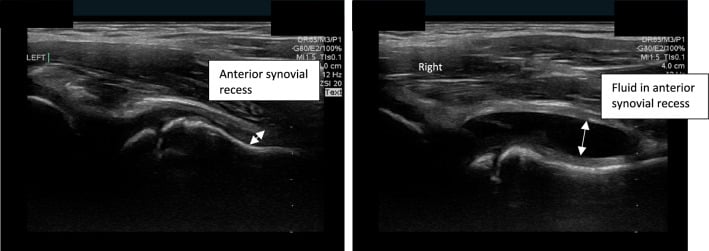 Side-by-side hip ultrasound: a normal anterior synovial recess on the side labelled left and fluid in the anterior synovial recess on the side labelled right.