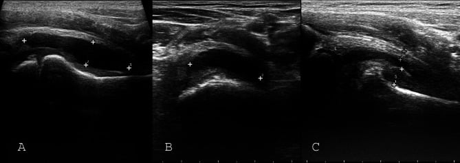 Three hip-ultrasound panels, A to C, with callipers placed to measure an anterior-recess effusion.
